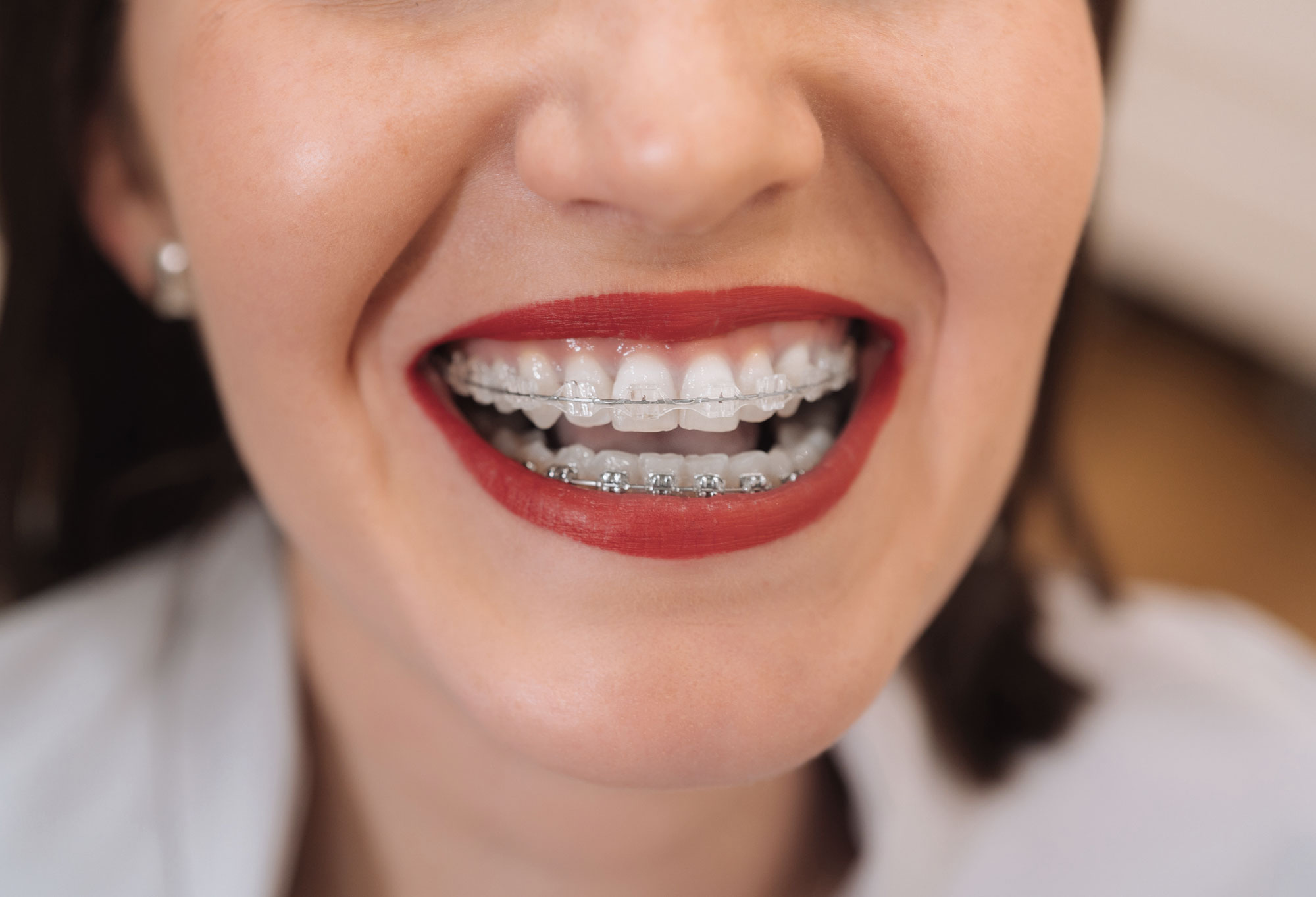 brackets estéticos de cerámica o zafiro en funes dental, clínica dental y estética en Málaga.