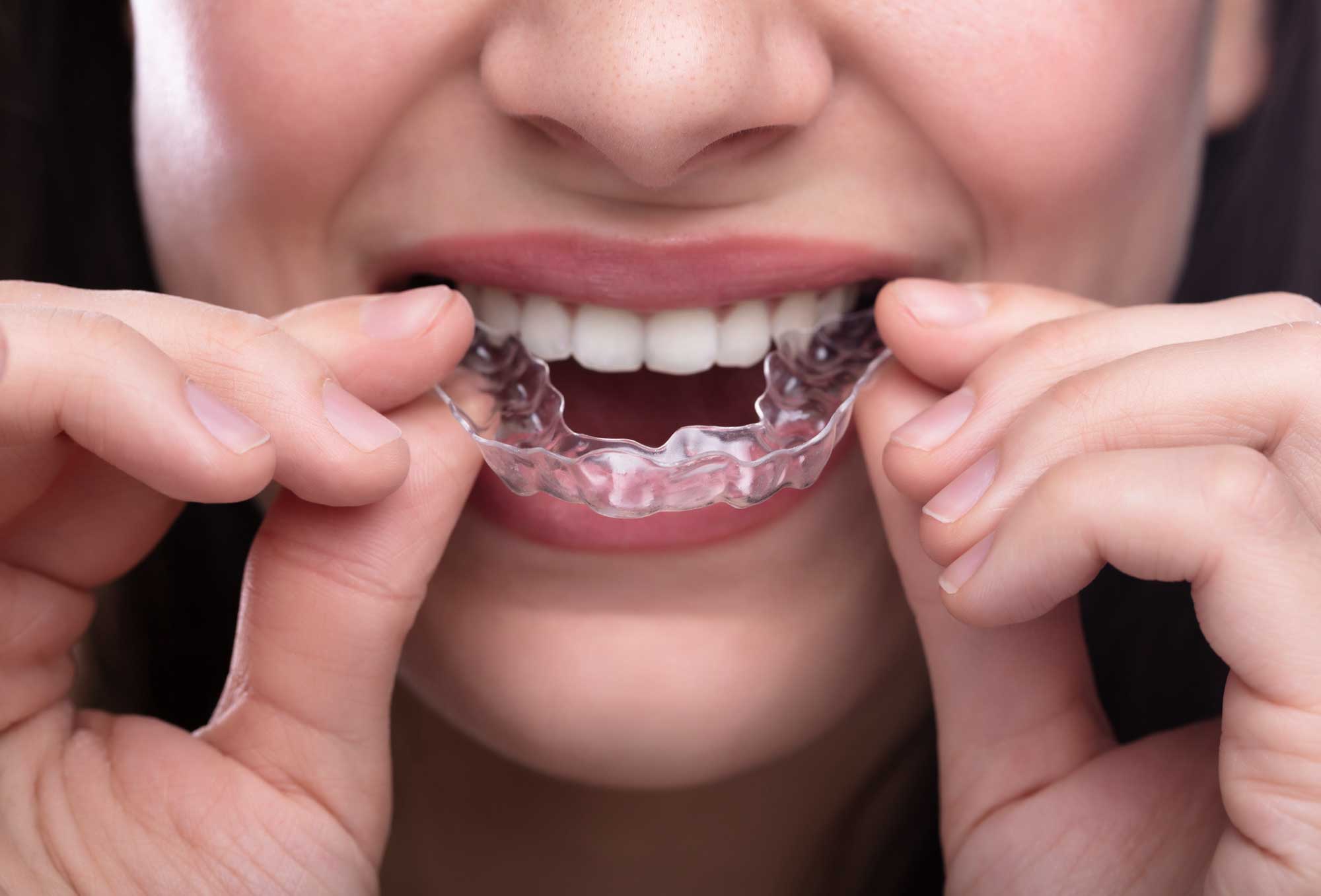 ortodoncia invisible en funes dental, clínica dental y estética en Málaga.