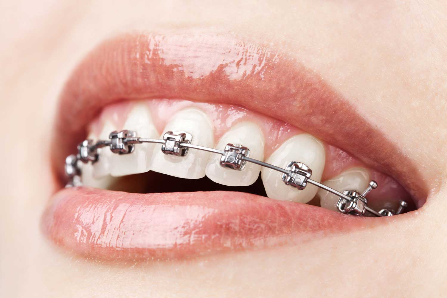 brackets tradicionales en funes dental, clínica dental y estética en Málaga.