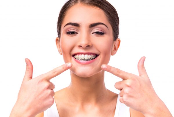 brackets autoligables