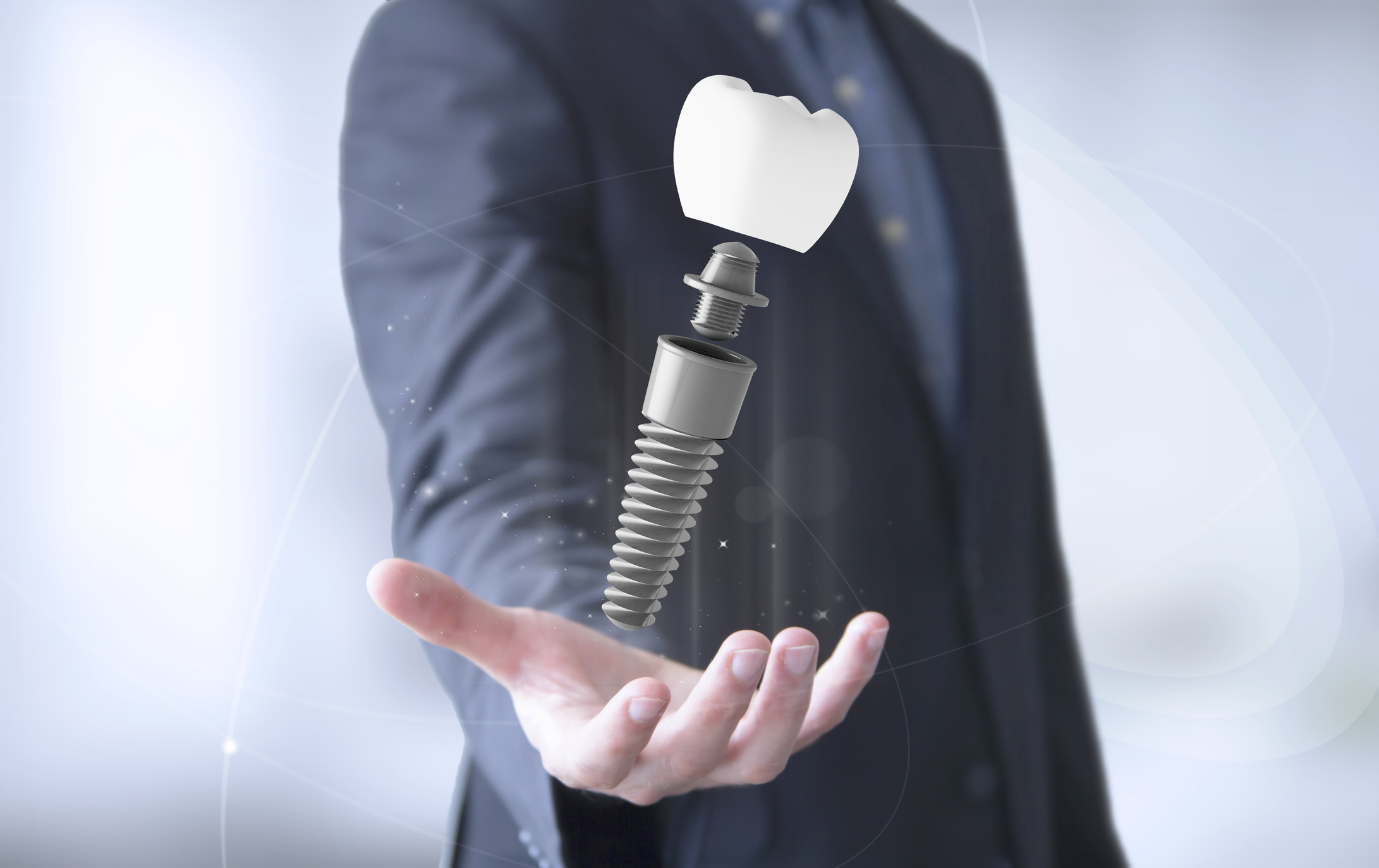 ¿Cómo cuidar los implantes dentales correctamente?