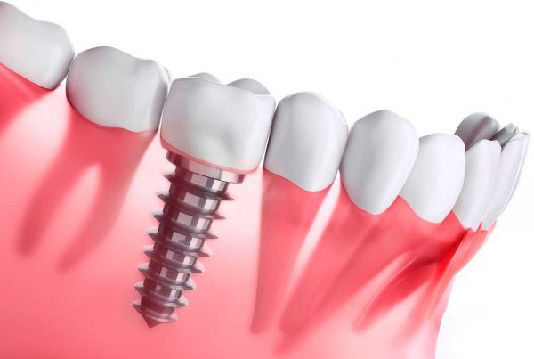 Implantes dentales