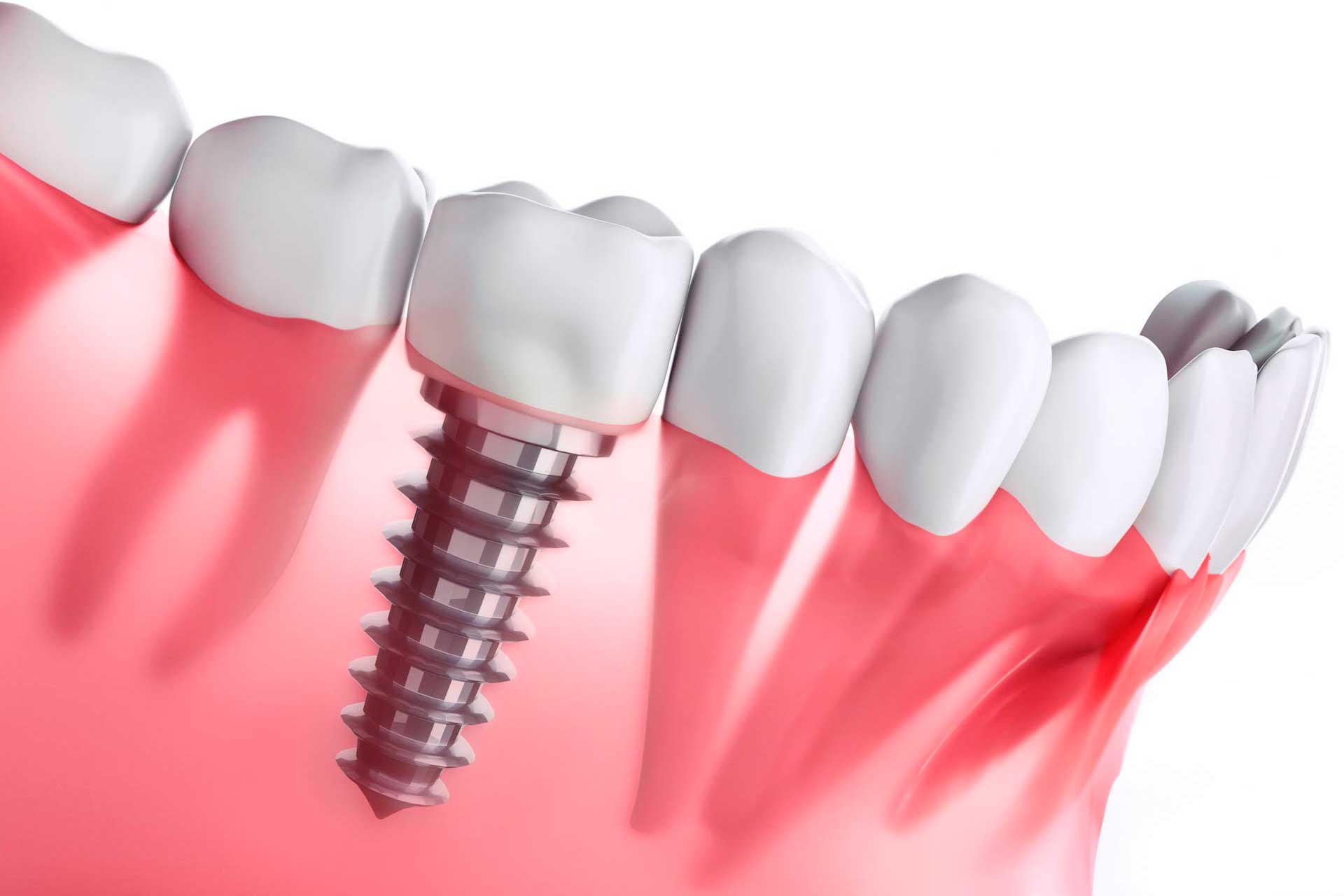 Ventajas de los implantes dentales