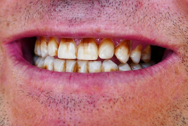 microabrasión dental