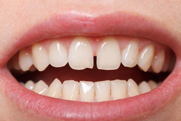 diastema dental