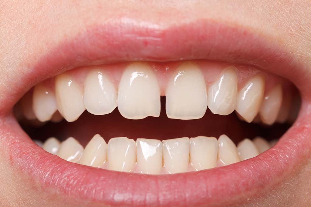 ¿Cómo se corrigen los diastemas dentales?