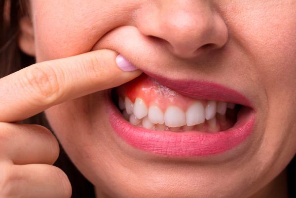 gingivitis