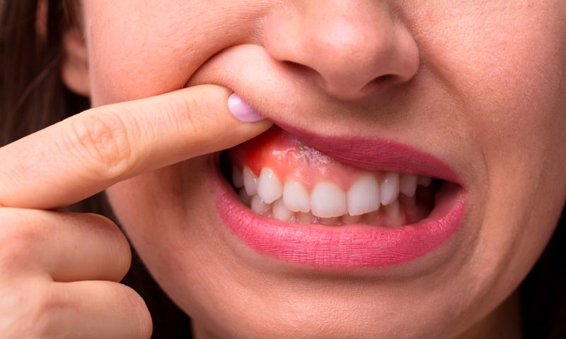 Gingivitis: 3 señales de alerta